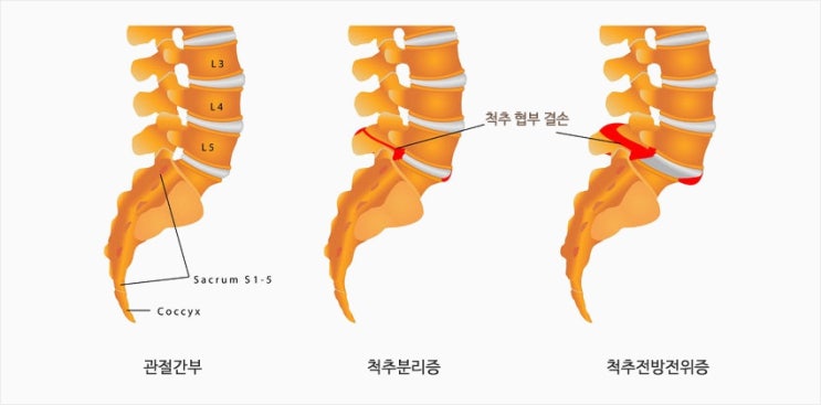  척추전방전위증｜허리통증, 방치하실 건가요?
