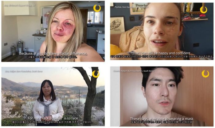 “화상 따른 상처도 장애로 인정해야” “화상 따른 상처도 장애로 인정해야”
