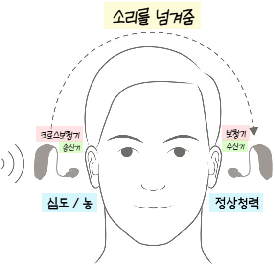  '편측성 난청(Unilateral Hearing Loss)'을 위한 제안, '크로스(CROS) 보청기' 소개