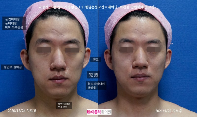 중안부 축소, 휜코, 인중 비대칭 교정 - 안면비대칭 교정 : 네이버 블로그 중안부 축소, 휜코, 인중 비대칭 교정 - 안면비대칭 교정 : 네이버 블로그