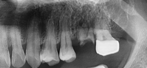 치아보철치료 미뤄선 안되는 이유
