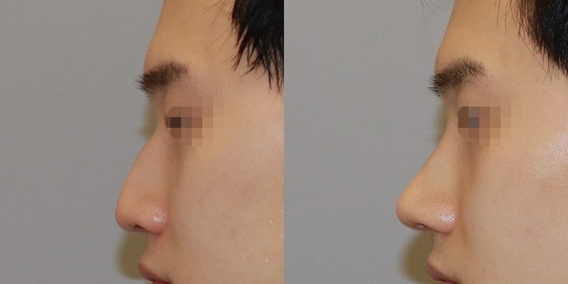 남자 매부리코 수술 교정 시술에 따라