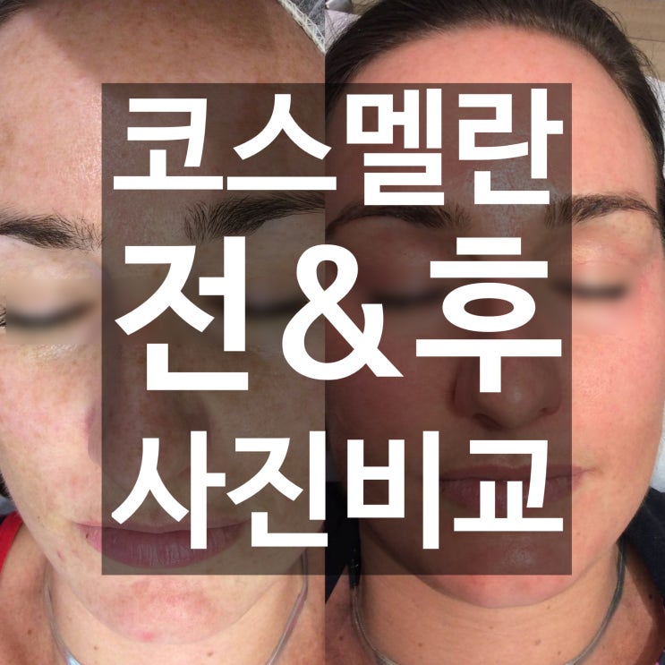  코스멜란 전 & 후 사진 비교분석 #3 (세번째)