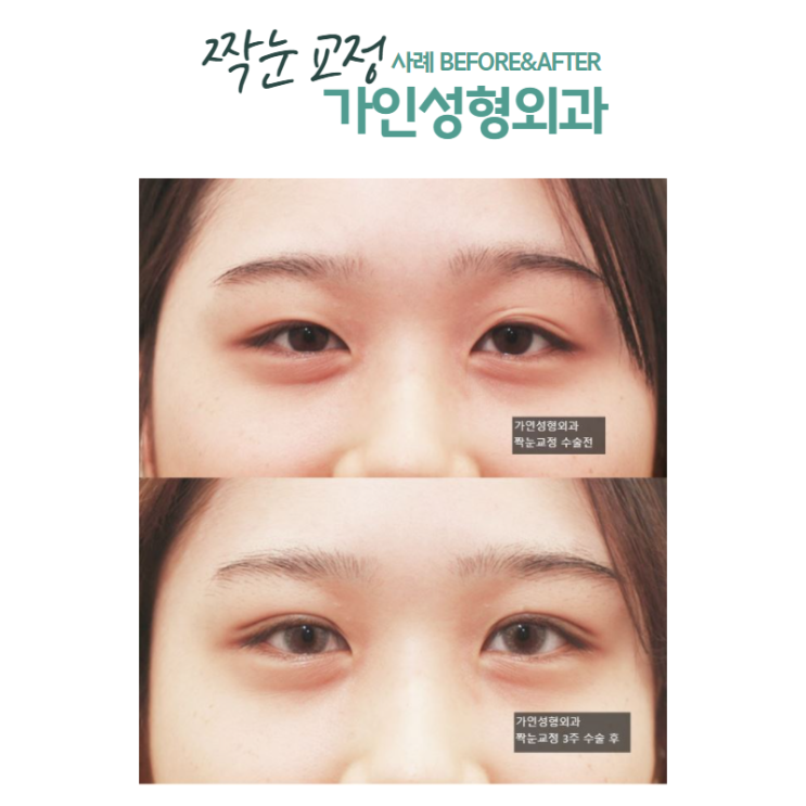  짝눈 교정 가장 중요한 포인트