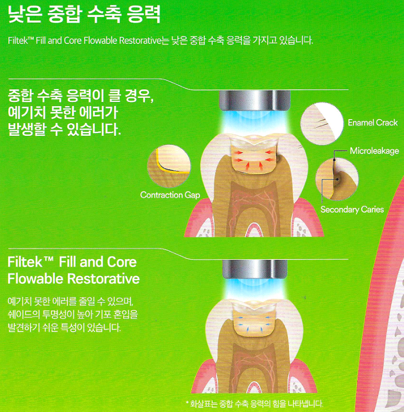 [레진] 3M Filtek Fill and Core Flowable Resin 설명 / 특징 : 네이버 블로그