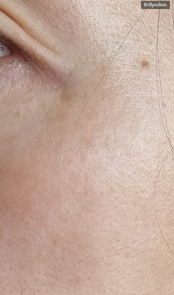  써마지 효과 대차대조