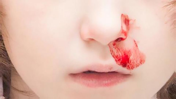  잦은 코피 원인과 해결 방법은?