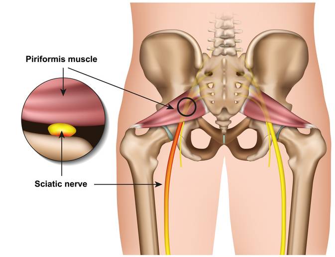  [이수역필라테스] 좌골신경통(Sciatica) 관련 편