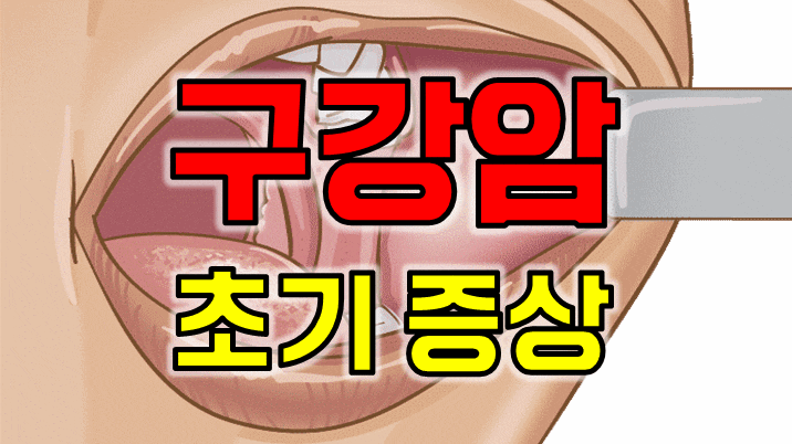  "혹시 구강암 아닌가요?" 반드시 알아야할 구강암 초기증상 5가지