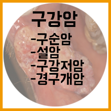 [목] 구강암-구순암, 설암, 구강저암, 협점막암, 경구개암