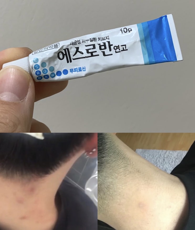  목드름 원인, 에스로반 연고로 모낭염 해결