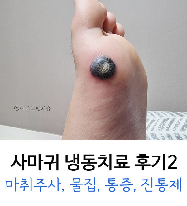 사마귀 냉동치료 후기 : 깨끗히