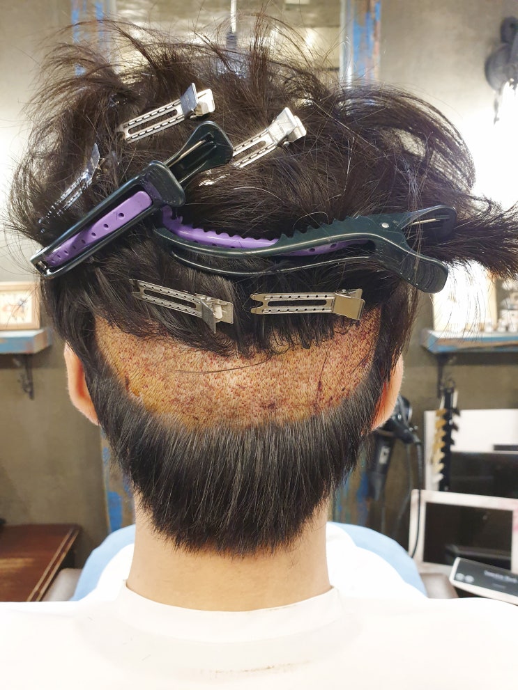  남자헤어라인 교정하기 전 준비해야 할 사항