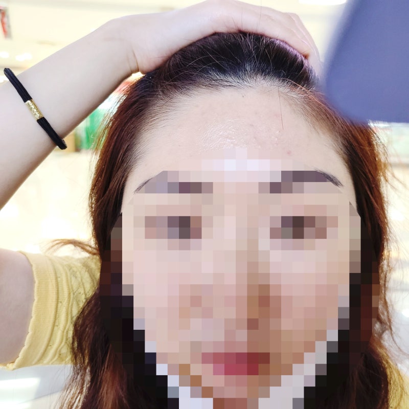 40대 얇은 피부 이마필러 후 4