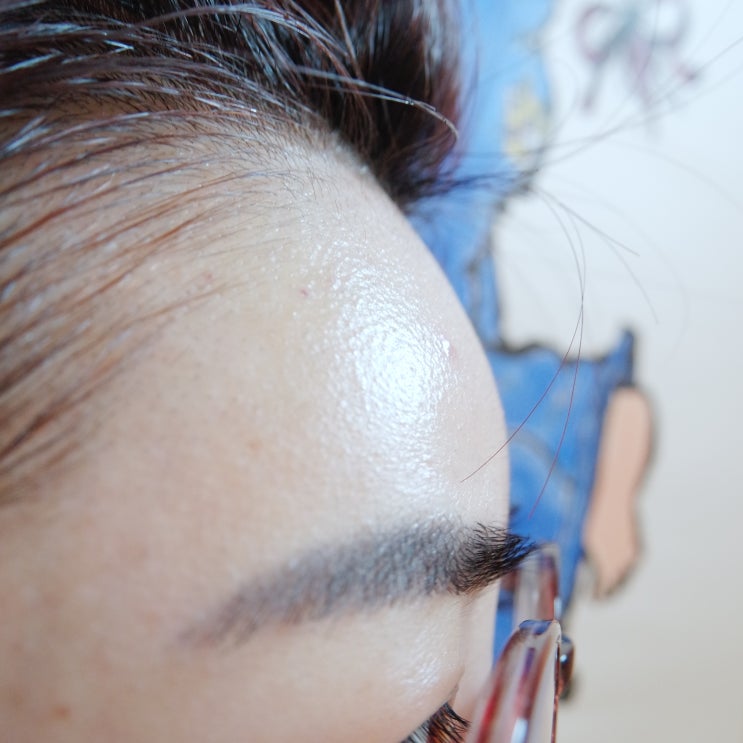  [대구]좁은이마필러 4cc후기 시술통증/리터치/몰딩까지 일주일동안의 기록 내돈내산 리얼후기