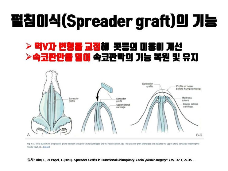  코수술 후 코막힘, 비중격만곡증, 짧은 코까지 교정 가능한 만능 수술, 펼침이식!!!