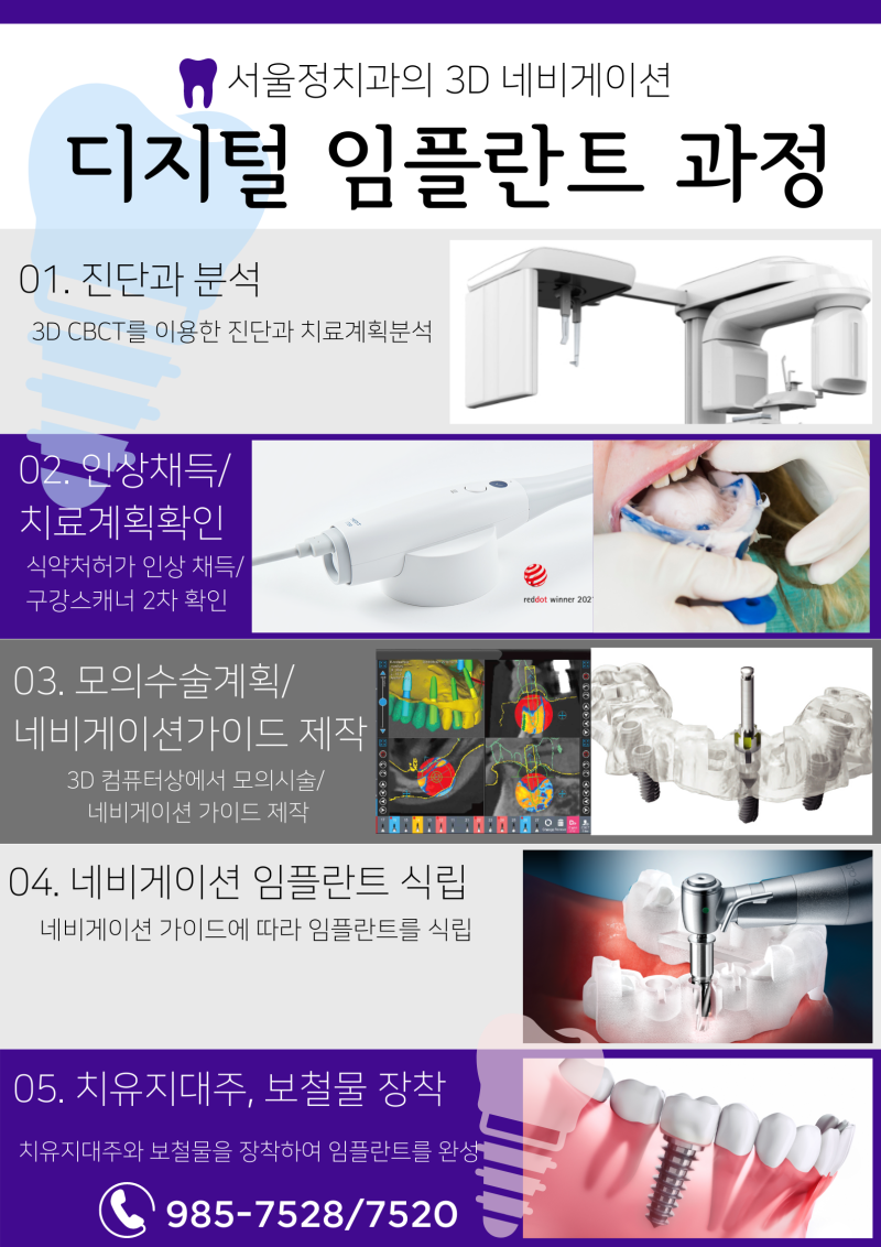 디지털 임플란트의 차이점 비교 2