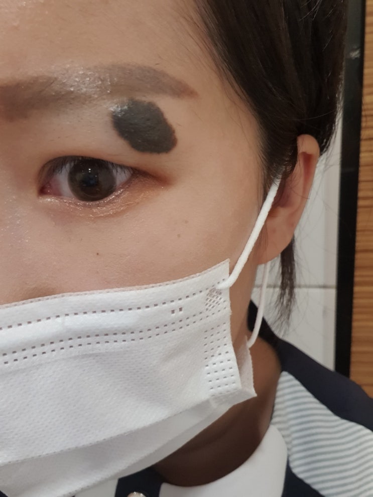  얼굴큰점 제거 수술  5개월 후 흉터 부위 사진 비용 등등