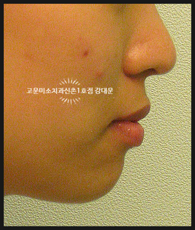  [교정]윗니 경사지고 입술이 두껍고 돌출입니다. 연세고운미소신촌1호점