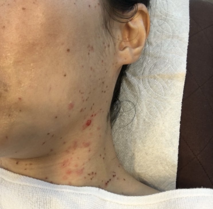  끝나지 않은 편평사마귀와의 전쟁.. 세번째 레이저 치료 후기