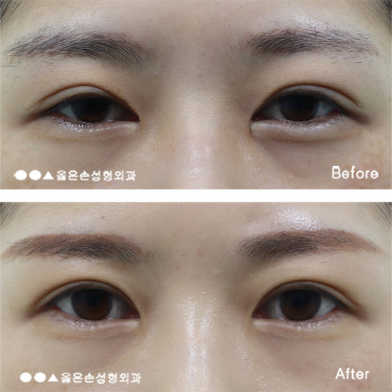  눈재수술잘하는곳 선택하는 방법