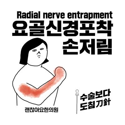  손저림, 요골신경포착