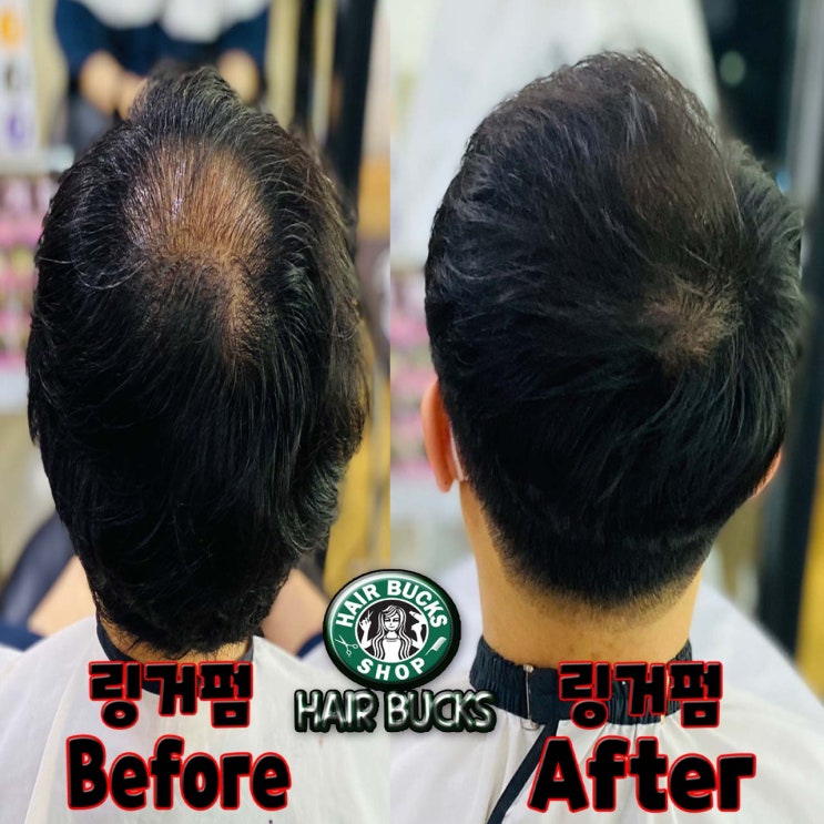  헤어벅스에서 역대급으로 탈모커버 했습니다 ! 이정도도 링거펌으로 커버가능합니다~!