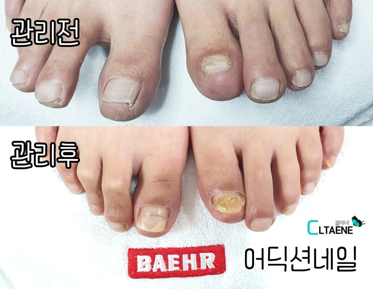  문제성 내성발톱 부천 상동 어딕션네일에서 관리 케어