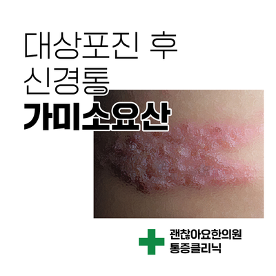  대상포진 후 신경통. 가미소요산 [통증의 한방치료 5] ②