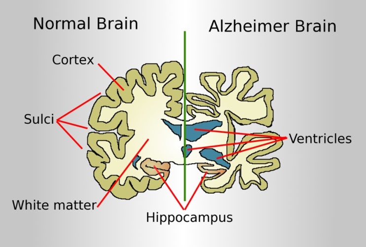 Alzheimer’s drug