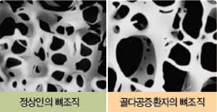  골다공증 원인증상 정상골밀도수치 약물치료방법:칼슘 비타민D효능 권장운동종류
