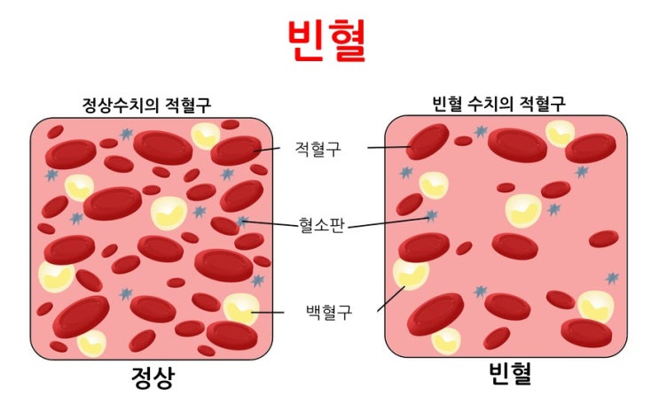  빈혈의 원인과 예방｜절대 가볍게 넘기시면 안 됩니다.