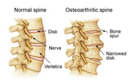 [이수역 필라테스] 요추 관절염 ( Osteoarthritis Lumbar ) 관련 편