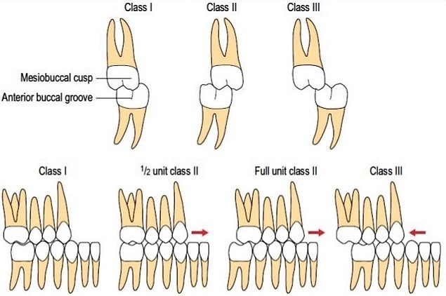 미사, 과개교합(앞니 깊은 교합)과 치아 불규칙을 동반한 II 급 부정교합의 상악 발치 교정 케이스 미사, 과개교합(앞니 깊은 교합)과 치아 불규칙을 동반한 II 급 부정교합의 상악 발치 교정 케이스