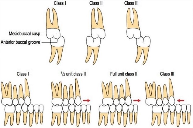 미사, 과개교합(앞니 깊은 교합)과 치아 불규칙을 동반한 II 급 부정교합의 상악 발치 교정 케이스