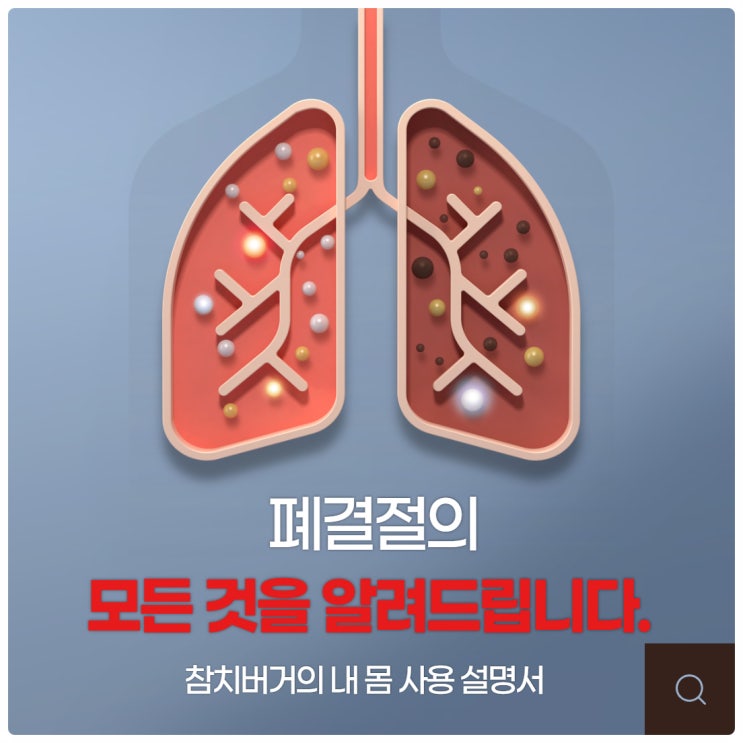 폐결절의 모든 것을 알려드립니다