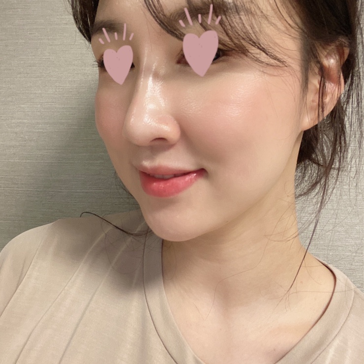  코필러 후기 코조각주사 콧볼줄이기