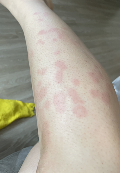 [임산부생활] 임신 6주차에 찾아온 두드러기?! (임신초기 알러지)