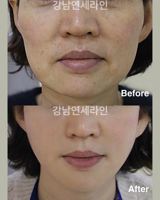  50대리프팅 실패하지 않는 비결