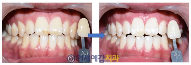  [광화문]해외에서도 찾아오는 원데이치아미백/회당'9만원대'(한번에3회시)/실제사례