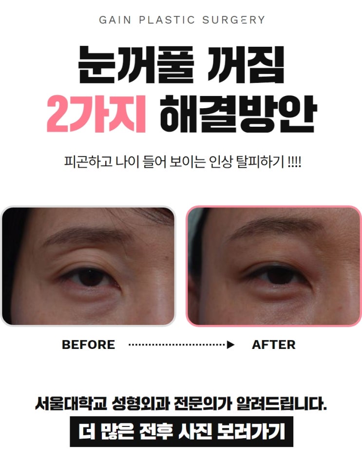  눈꺼풀 꺼짐 해결책 2가지