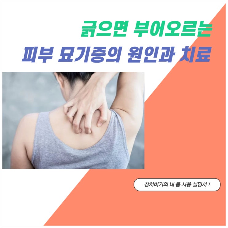  피부 묘기증이라고 아시나요 긁으면 부어 오르는 피부 묘기증