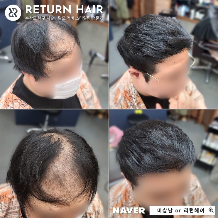   20대부터 넓어지는 이마 고민? M자 및 정수리 탈모는 미용실 히든펌 파마로 개선 가능!
