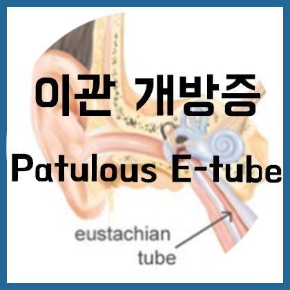  [귀] 이관 개방증(Patulous Eustachian tube)