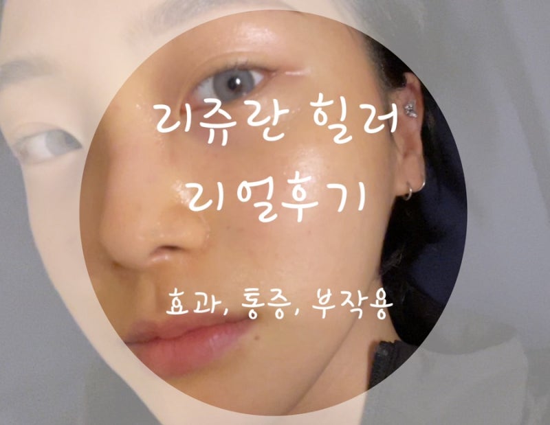 이수역 피부과에서 추천하는 리쥬란힐러 (리쥬란효과, 소요시간, 통증, 바늘자국)