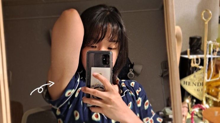  지방분해주사 찐 후기 뚠뚠한 팔뚝 조지기