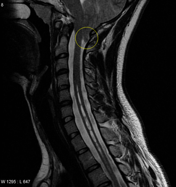 Case report 1) 아놀드-키아리 증후군 제1형을 동반한 척수공동증
