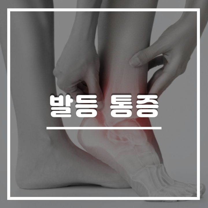  발등 통증 원인 및 아픈이유, 효과적인 스트레칭 : 결절종, 피로골절