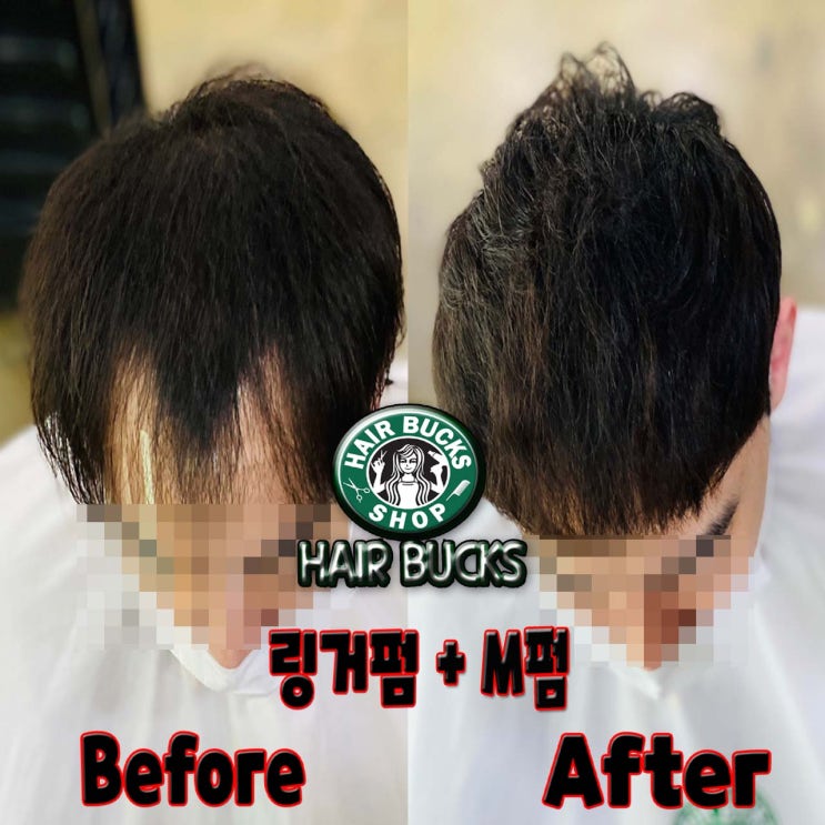  탈모커버엔 역시 링거펌 !! 링거펌으로 단점커버 탈모커버하세요~!