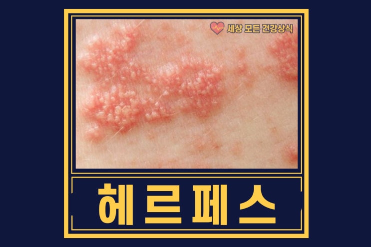  남자, 여자 헤르페스 2형 증상 및 치료 ( 입술, 바이러스 )